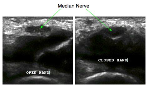 Ultrasound Measurements | Carpal-Tunnel.net