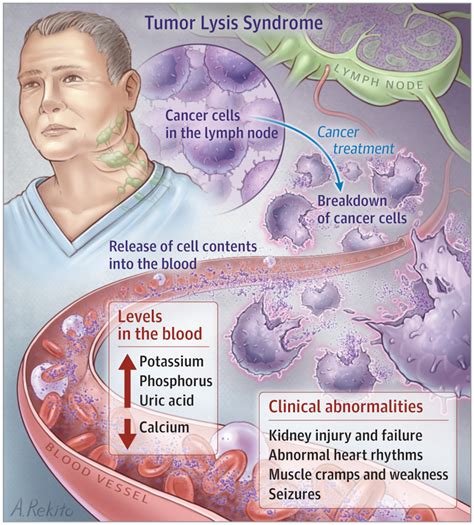 Tumor Lysis Syndrome. | Hematology | JAMA Oncology | JAMA Network ...