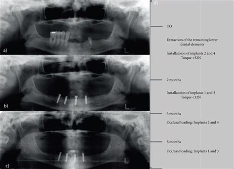 (a) Preoperative panoramic X-rays; (b) panoramic X-rays with... | Download Scientific Diagram