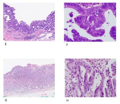 Examples of over-diagnosed cases. (A, B) Low grade dysplasia originally... | Download Scientific ...