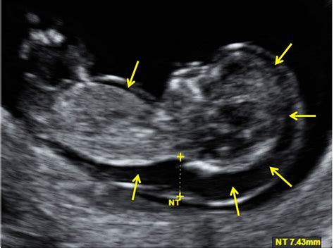 What Does Nt Mean On Baby Scan / When And Why To Get Ultrasounds During Pregnancy The New York ...