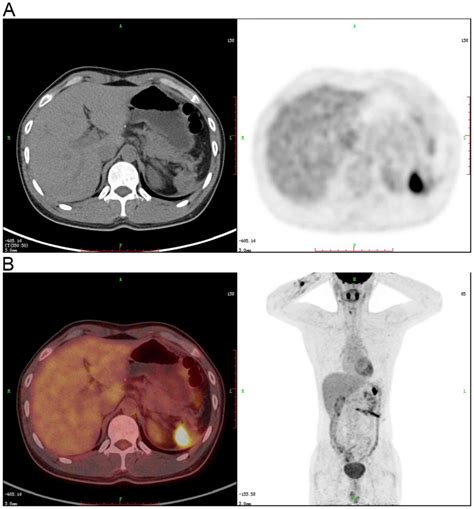 Squamous cell carcinoma of the spleen: A case report