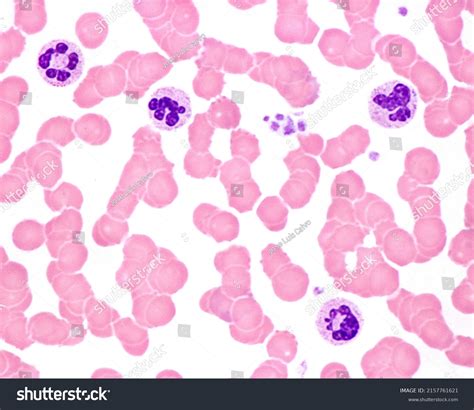 Human Blood Smear Leukocytosis Acute Infection ภาพสต็อก 2157761621 | Shutterstock