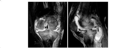 MRI (anteroposterior and lateral): synovial hypertrophy, unclear ...