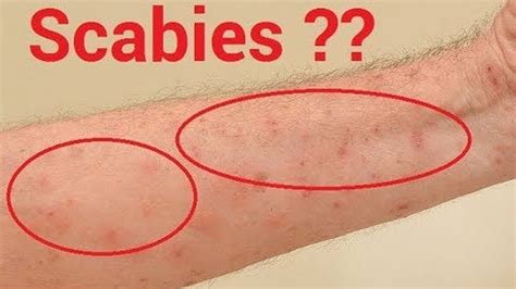 How To Know If You Have Scabies, And 7 Natural Treatments That Work Fast - YouTube