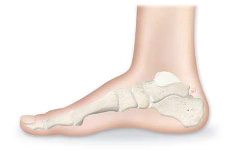 Pes Planus: symptoms and diagnosis | Limbhealing.com