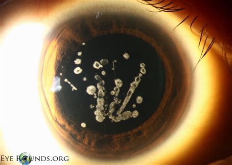 Atlas Entry - Granular corneal dystrophy