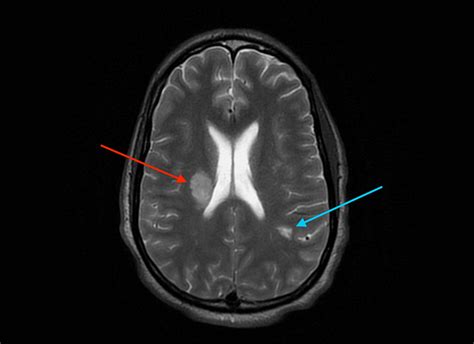 Neurosyphilis Mri