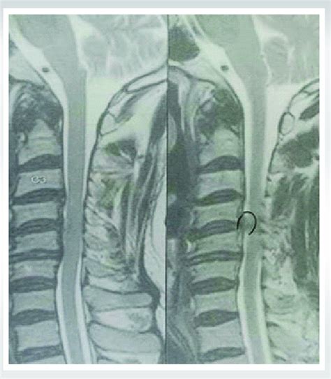 MRI T2 images cord edema and myelomalacia changes at C4C5 level. | Download Scientific Diagram