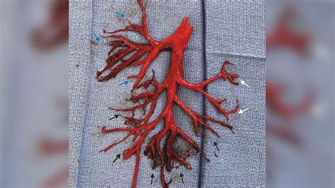 Man coughs up blood clot in perfect shape of bronchial tree - ABC7 Los Angeles