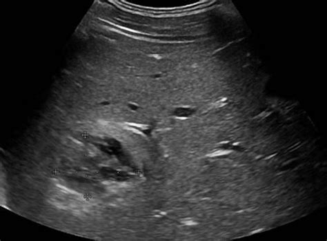 June 2015 | Ultrasound Cases