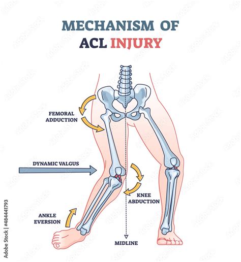 Mechanism of ACL injury as knee trauma anatomical explanation outline ...