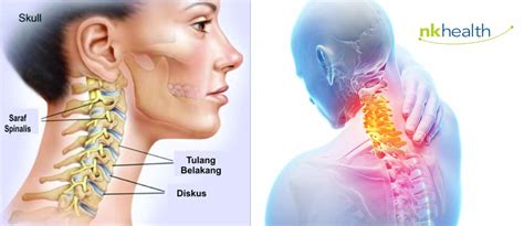 Fisioterapi HNP Cervical - Saraf Kejepit Leher - Klinik Fisioterapi Jakarta