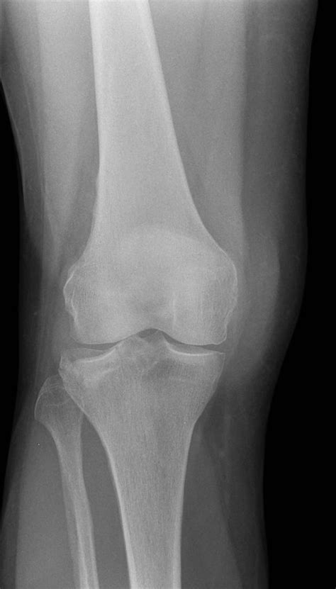 Tibial Condyle Fracture