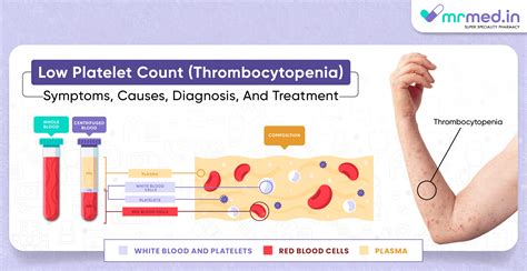 Low Platelet Count (Thrombocytopenia): Symptoms, Causes, Diagnosis, and Treatment | MrMed