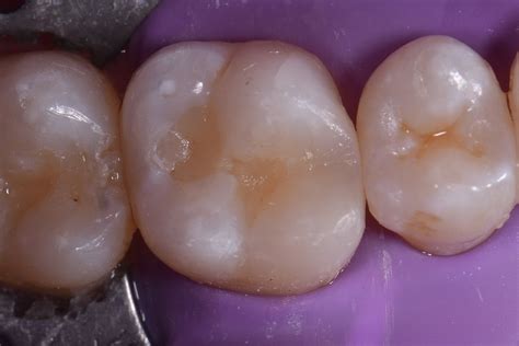 Small Cavities Restored in the Zone of Excellence | Restorative Dentist ...