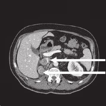 Inferior Vena Cava Ct Scan