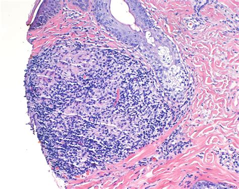 VIRTUAL GRAND ROUNDS IN DERMATOLOGY 2.0: Granulomatous Rosacea