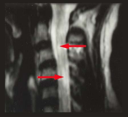 Cervical Spine Mri Multiple Sclerosis