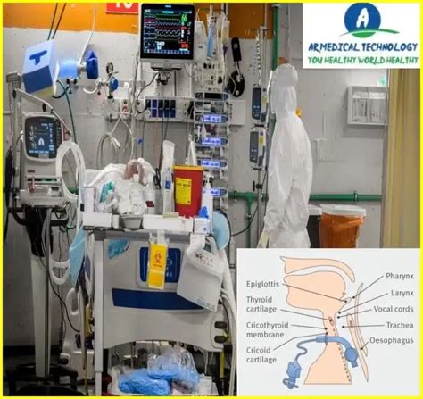 Tracheostomy vs intubation Archives