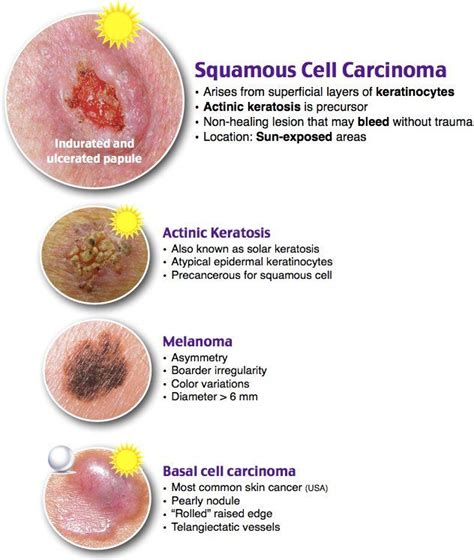 Basal Cell Carcinoma Vs Squamous Cell Carcinoma - AshantigroWhitehead