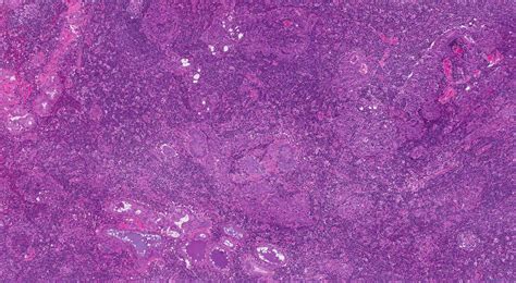 Acinic cell carcinoma of the salivary glands | Ottawa Atlas of Pathology