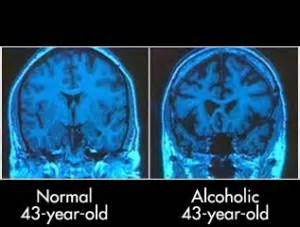 Alcohol: Effects on Neurobehavioral Functions and the Brain | Ballard Psychiatry