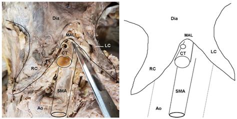 Lateral Arcuate Ligament