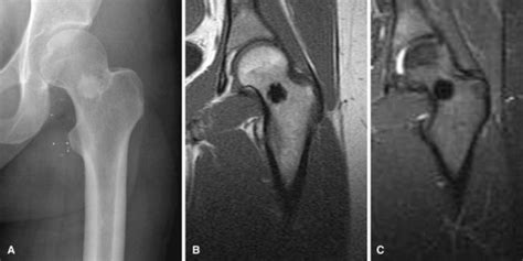 Bone Island Mri