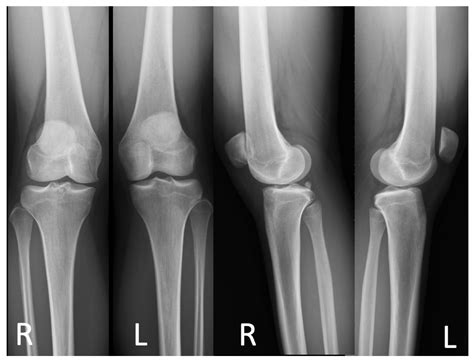 Medicina | Free Full-Text | Reconstruction of High-Grade Trochlea Dysplasia in a Young Female ...