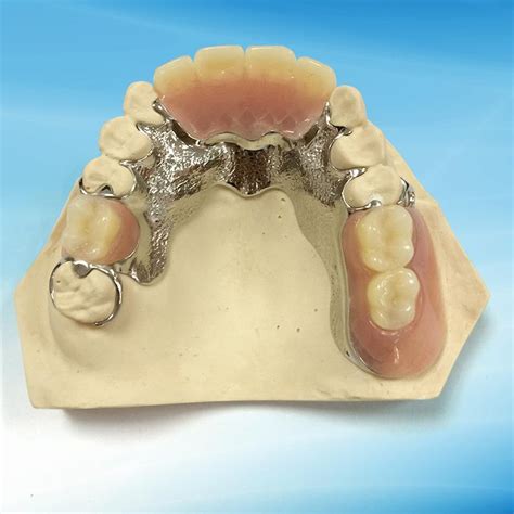 horseshoe partial denture design - vansvangoghline