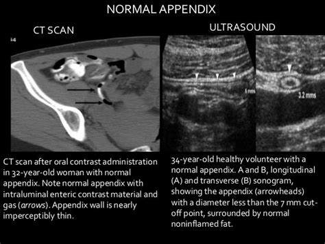 Imaging of Acute Appendicitis