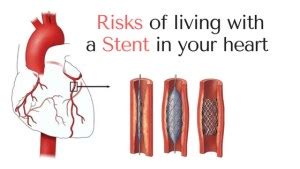 Living with a stent in your heart? You should know these risks