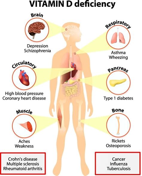 Pin on Vitamin D Deficiency Treatments