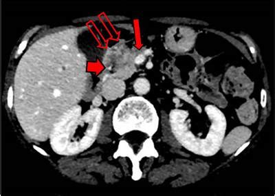 Frontiers | A Patient With Stage III Locally Advanced Pancreatic ...