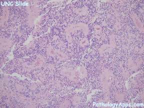 ependymoma brain, spinal histology