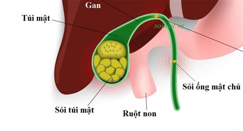 Ascaris Mimicking Common Bile Duct Stone A Case Repor - vrogue.co