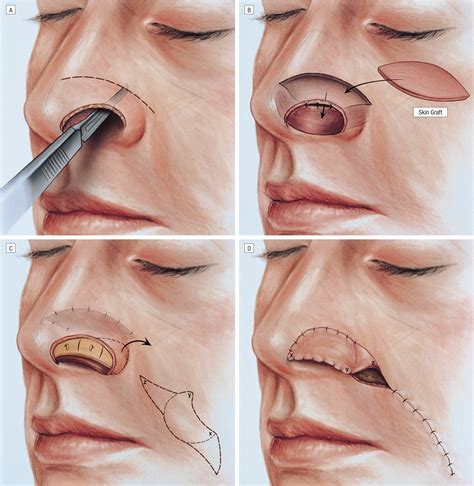 Reconstruction of Nasal Alar Defects | JAMA Facial Plastic Surgery ...