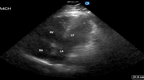 Saddle PE Apical 4 chamber US, annotated JETem 2019 - YouTube