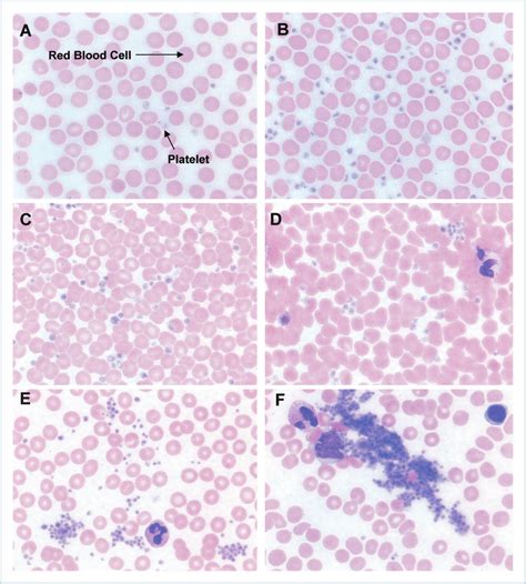 The morphology of platelets in platelet-rich plasma (PRP) change as a ...