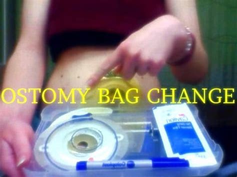 How I change my ostomy bag - YouTube