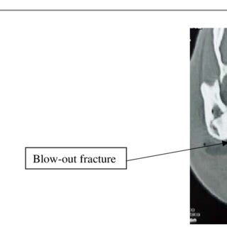 CT scan, frontal section. Blow-out fracture of the right orbital floor. | Download Scientific ...