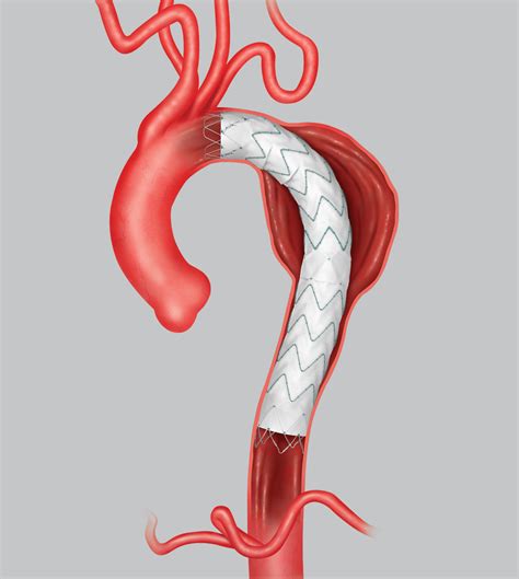 Cook Medical receives FDA approval for the Zenith Alpha™ Thoracic Endovascular Graft | Aortic ...