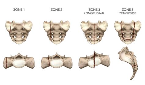 Sacral Fracture Classification