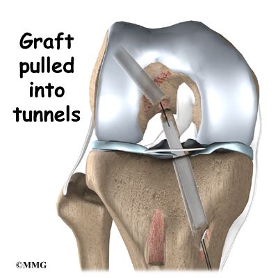 Patellar Tendon Graft Reconstruction of the ACL | eOrthopod.com