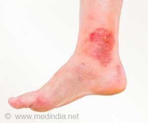 Chromoblastomycosis - Skin Disease: Causes, Symptoms, Diagnosis, Treatment, Health Tips