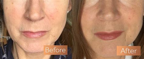 Absolute Collagen Before and After Pictures | Incredible Results