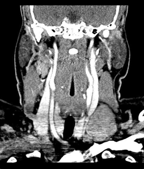 Differential Diagnosis of Cervical Lymphadenopathy