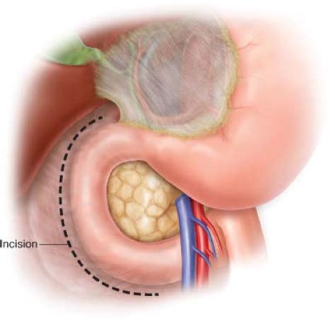 Surgery for Gastrinoma | Abdominal Key