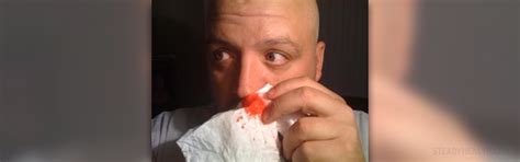 Bloody nose causes | General center | SteadyHealth.com